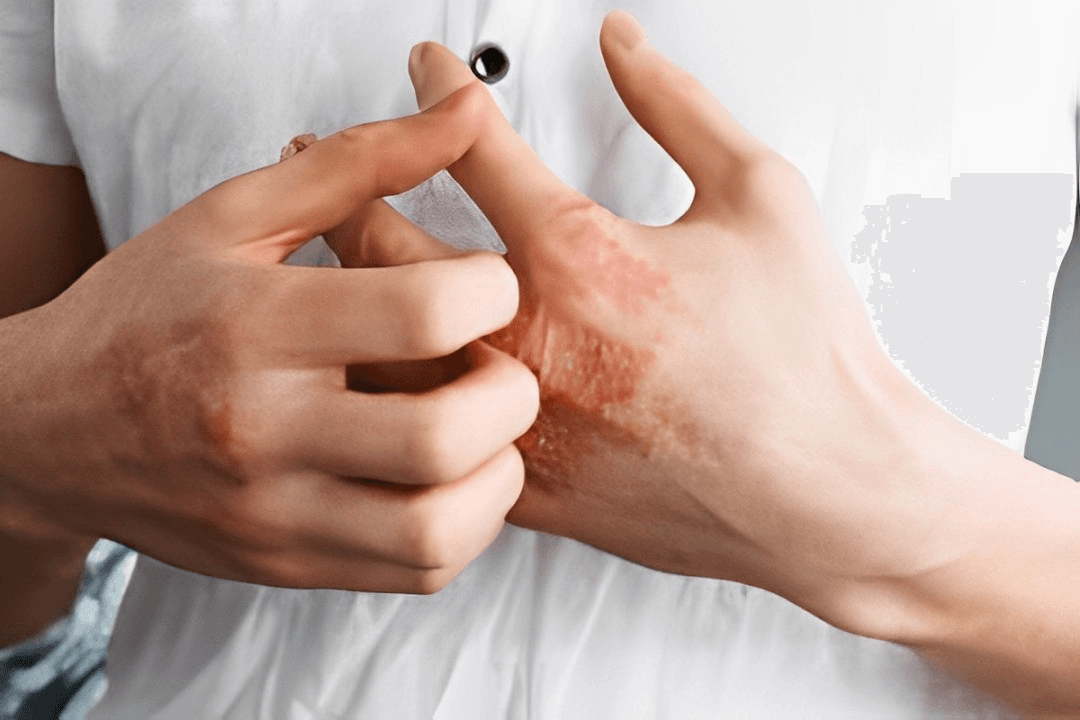 LEO Pharma's Chronic Hand Eczema Study Makes Headlines In The Lancet