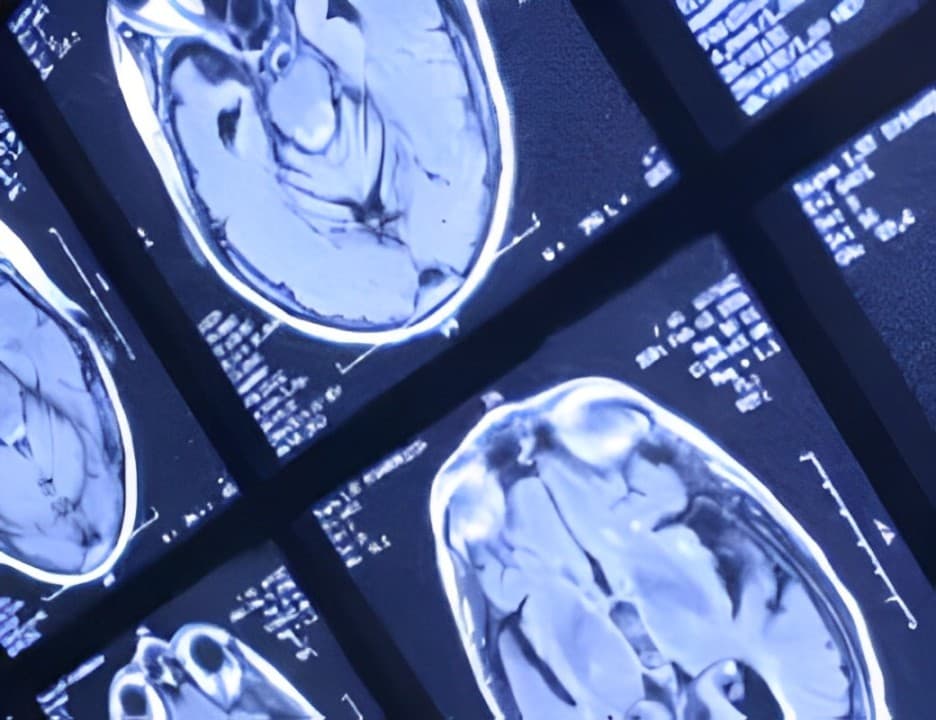 Lantern Pharma’s LP-184 Secures FDA Fast-Track Status In Battle Against Glioblastoma