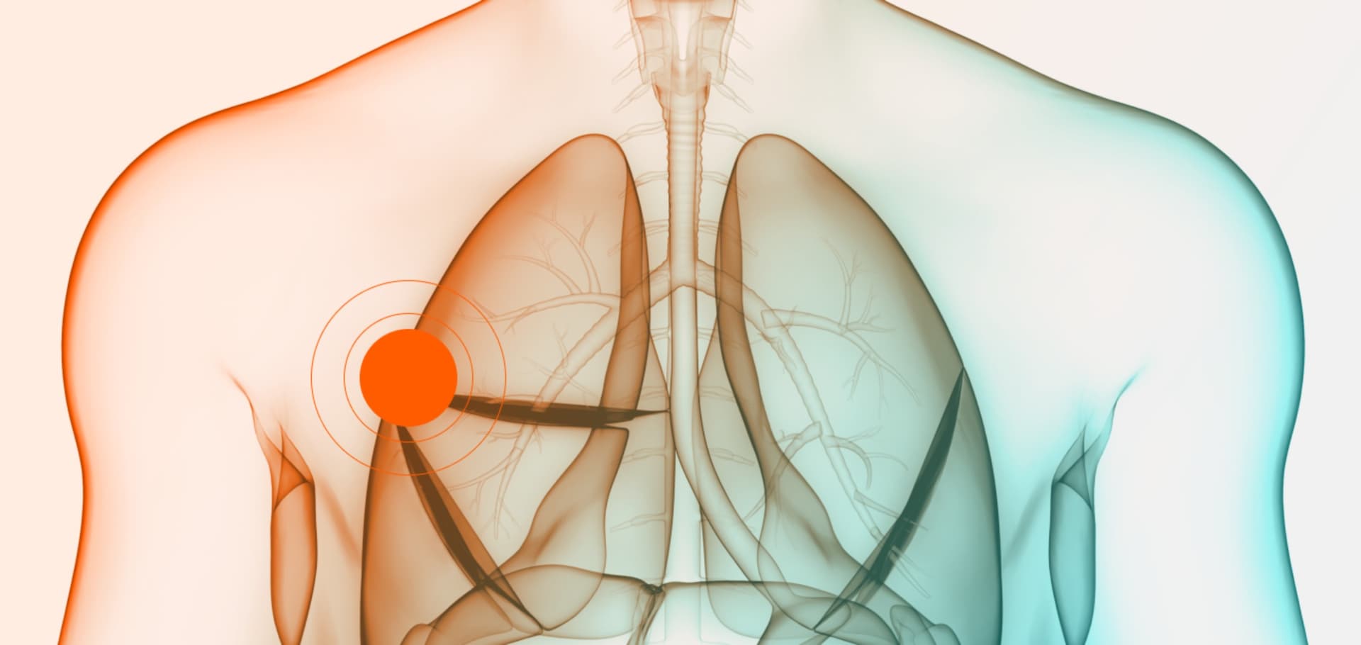 Cizzle Biotech Partners with Moffitt Cancer Center for Early Lung Cancer Detection