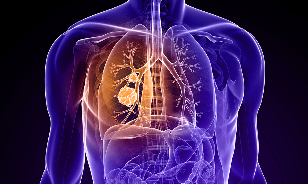Ivonescimab Outperforms Keytruda in NSCLC, Shows Promise as New Standard of Care