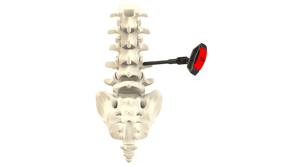 SurGenTec's FDA-Approved B-MAN Bone Marrow Aspirate Kit Revolutionizes Cell Extraction