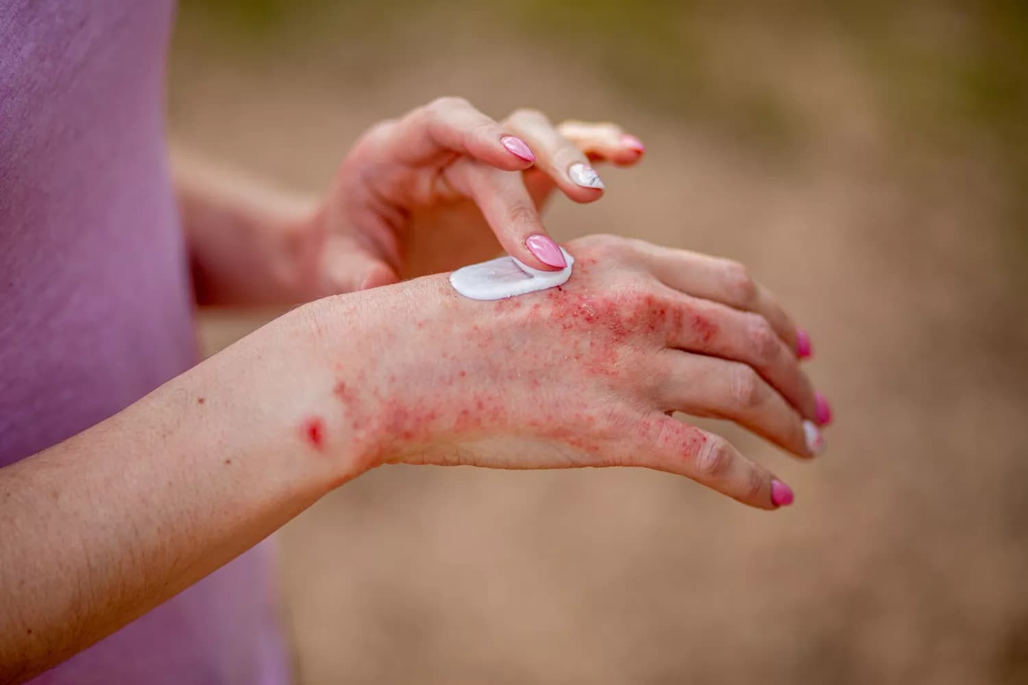 European Commission Approves Anzupgo® Cream for Chronic Hand Eczema Treatment by LEO Pharma