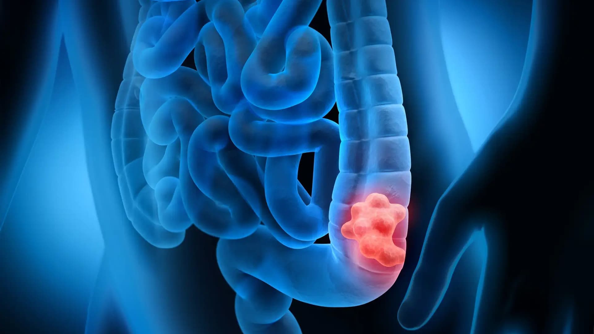 Takeda Wins Approval For New Colorectal Cancer Drug FRUZAQLA In Japan