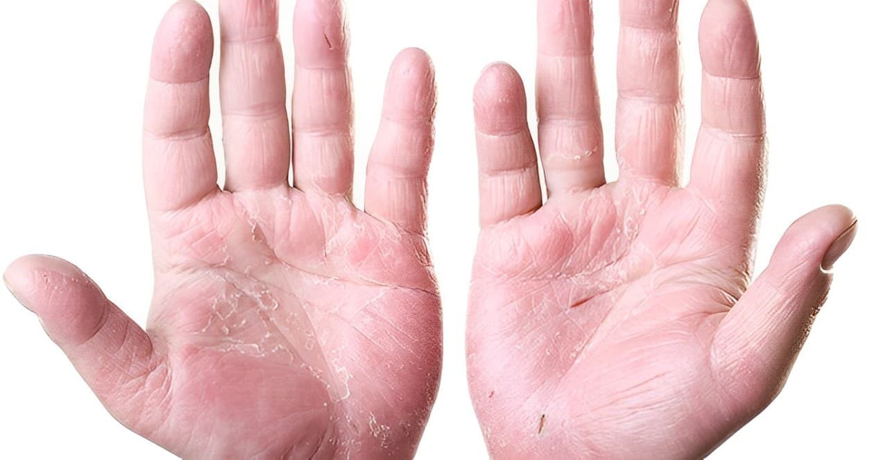 LEO Pharma's Latest Study Sheds Light on Chronic Hand Eczema Severity and Treatment