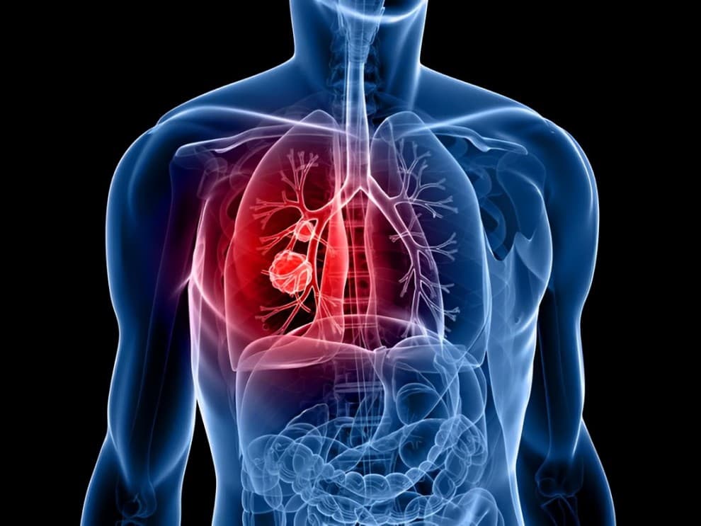 NMPA Approves First NGS-Based EGFR Exon20ins CDx for Lung Cancer