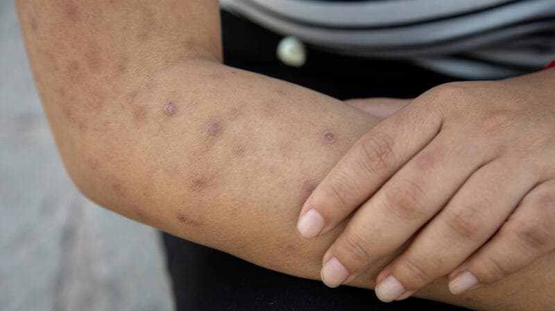 Galderma's New Skin Treatment Gets FDA Nod, A Victory for Dermatology